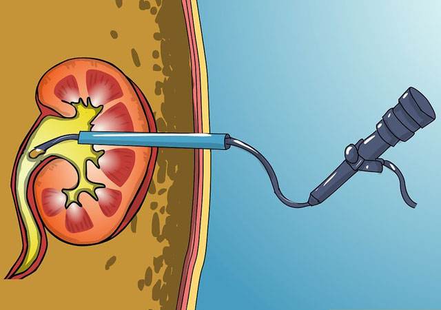 经皮肾镜取石技术